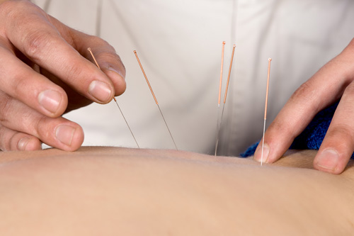 dry-needling